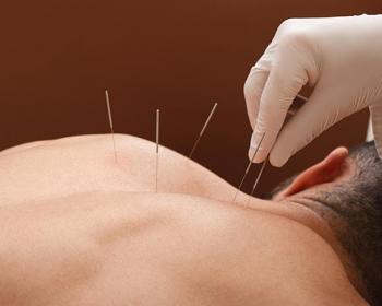 acupuncture-2-3.jpg